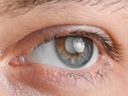 Closeup view of man before and after glaucoma treatment, closeup